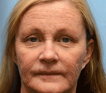 [🔥Last Day 70% OFF] ODALIT™ Botox & Retinol Shot - Eraser for Deep Wrinkles, Sagging Jowls & Puffy Eyes